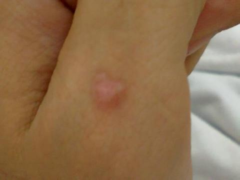 引发寻常疣的原因有哪些