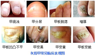 勃起障碍症状图片
