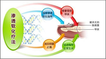 中医渗透软化疗法治疗勃起障碍