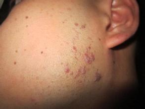 扁平疣不治疗会有什么危害