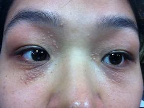 扁平疣发病原因是什么