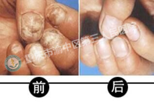 勃起障碍治疗前后对比图