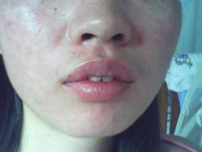 睾丸炎的朋友需要注意哪些事项